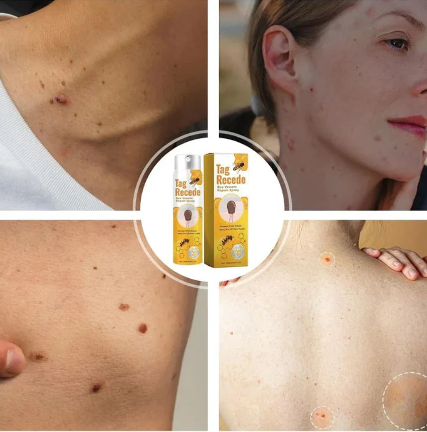 BeeFree™ Despídete de verrugas y lunares en 5 días - Bee Venom Spray®